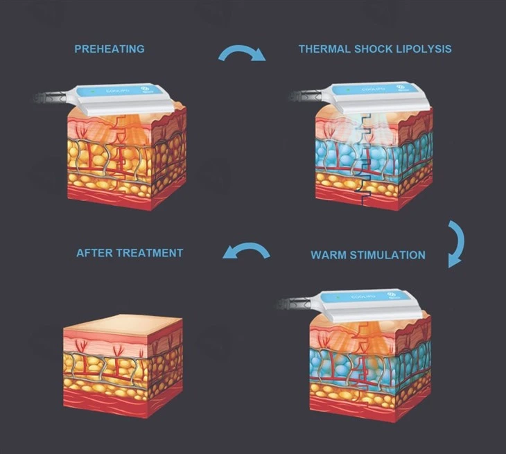 4 Handle Cryoskin Machine